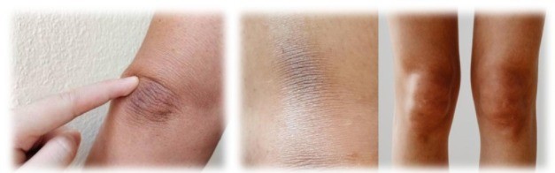 Etude clinique test coudes genoux foncés